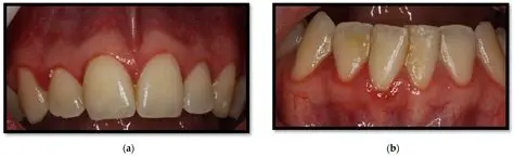 Factors That Can Aggravate Gingival Inflammation