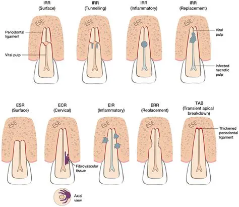 The Prevalence of External Root Apical Resorption in Patients in the USU FKG Orthodontic Clinic