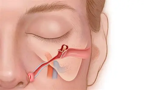The Risks of Sinus Blockage During Flight